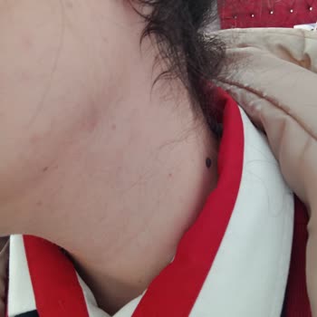 Yüz Lazer Epilasyonda Söz Verilen %80 Azalma Sağlanmadı, Personel Sürekli Değişti