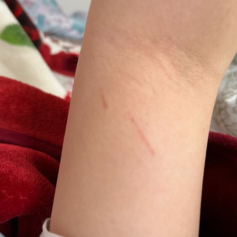 Estetiva’da 1 Günlük Cayma Süresi Ve Ağrılı Lazer Seansı Nedeniyle Sözleşme Feshi Talebi