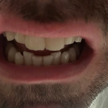 Only Tedavisi Kırıldı Ve Estetik Dolgular Sorunlu, Yüksek Ücret Ve Mağduriyet