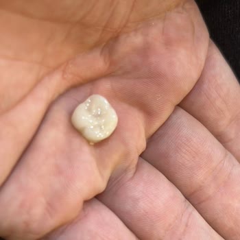 Only Tedavisi Kırıldı Ve Estetik Dolgular Sorunlu, Yüksek Ücret Ve Mağduriyet