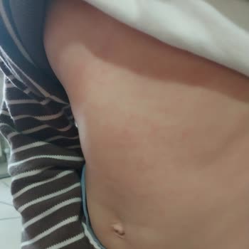 Abdi İbrahim Grintuss Pediatrik Şurup Yan Etki İhtimali