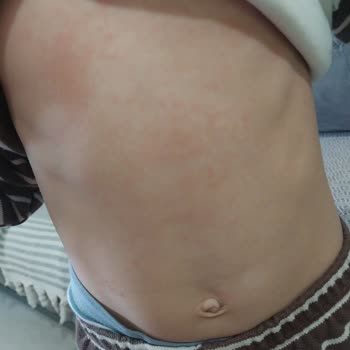 Abdi İbrahim Grintuss Pediatrik Şurup Yan Etki İhtimali