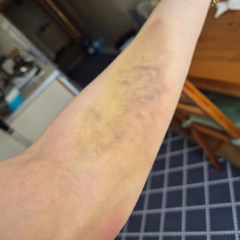 Pendik Bölge Hastanesi Kan Alımında Şiddetli Ağrı Ve Şişlik Nedeniyle İade Talebi