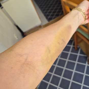Pendik Bölge Hastanesi Kan Alımında Şiddetli Ağrı Ve Şişlik Nedeniyle İade Talebi
