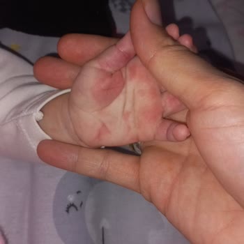 Bebeğimde 9 Tüp Kan Alımı Sırasında Aşırı Sıkma Ve Morluk