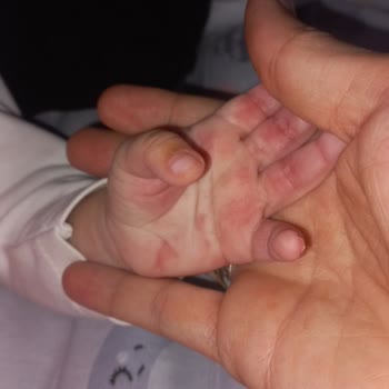 Bebeğimde 9 Tüp Kan Alımı Sırasında Aşırı Sıkma Ve Morluk