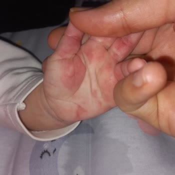 Bebeğimde 9 Tüp Kan Alımı Sırasında Aşırı Sıkma Ve Morluk