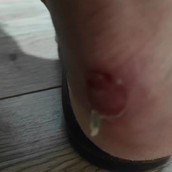 Ayakkabının Kısa Sürede Yara Açması Ve Mağazanın Kullanıcı Hatası İddiası