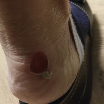 Ayakkabının Kısa Sürede Yara Açması Ve Mağazanın Kullanıcı Hatası İddiası