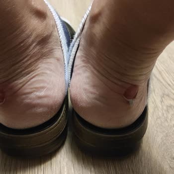 Ayakkabının Kısa Sürede Yara Açması Ve Mağazanın Kullanıcı Hatası İddiası