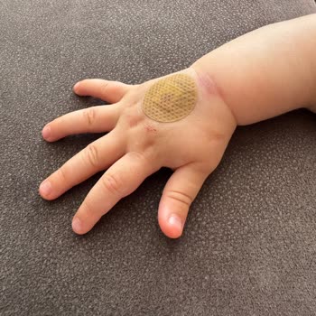 Hemşire Hatası Nedeniyle Çocuk Kan Alımında Tekrar Ziyaret Ve İdari İnceleme Talebi