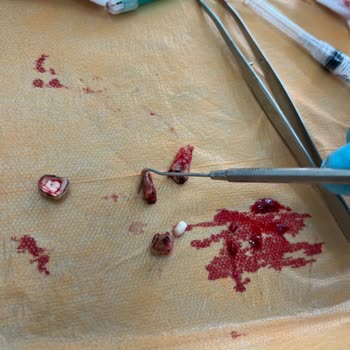 Zonguldak Ağız Ve Diş Sağlığı Merkezi Yanlış Tanı Ve Gereksiz Köprü İşlemi Sonrası Ağrı