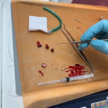 Zonguldak Ağız Ve Diş Sağlığı Merkezi Yanlış Tanı Ve Gereksiz Köprü İşlemi Sonrası Ağrı