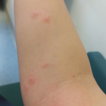 Baza Başlığındaki Tahta Kuruları: Sağlık Sorunu Ve Ücret İadesi Talebi