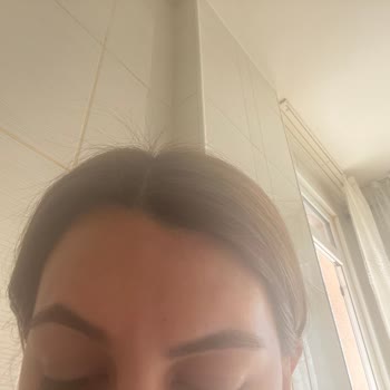 Yetersiz Eğitimli Uzman Nedeniyle Botoks Ve Dolgu İşlemlerinde Asimetri Ve İade Talebi