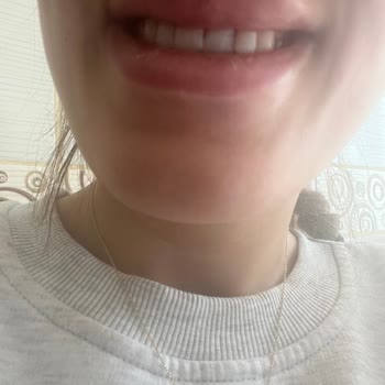 Yetersiz Eğitimli Uzman Nedeniyle Botoks Ve Dolgu İşlemlerinde Asimetri Ve İade Talebi