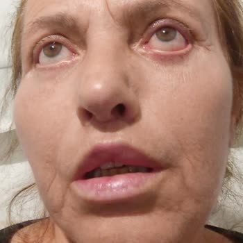 estetik ameliyat sonrası mağduriyet Tam Paket Sözleşmesi İhlali, Alın Germe İadesiz Ve Göz Kapağı Kalıcı Sorunları