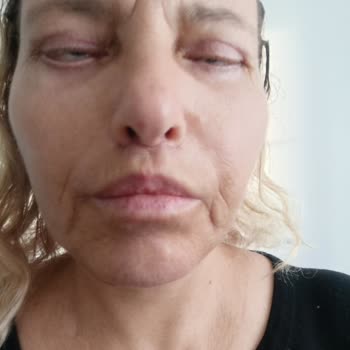 Tam Paket Sözleşmesi İhlali, Alın Germe İadesiz Ve Göz Kapağı Kalıcı Sorunları