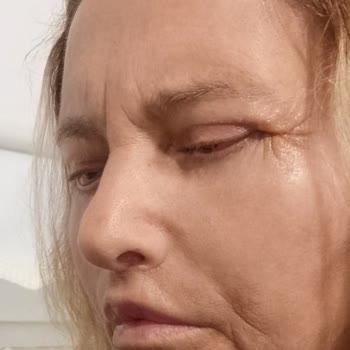 Tam Paket Sözleşmesi İhlali, Alın Germe İadesiz Ve Göz Kapağı Kalıcı Sorunları