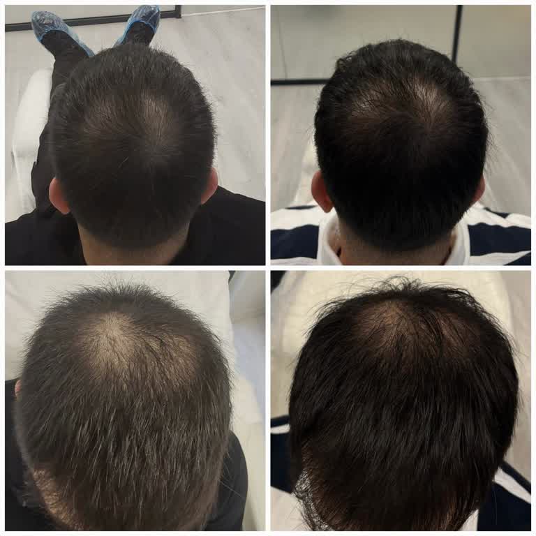 S'Clinic Yoğun Kaşıntı Ve Ciddi Seviyede Saç Dökülmesi Yaşamaya Başladım