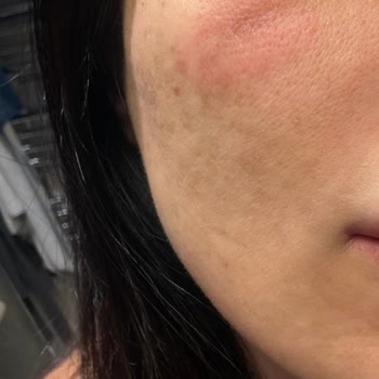 Ciltte Kızarıklık Ve Şişlik, İade Ve İnceleme Talebi