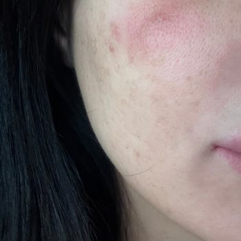 Ciltte Kızarıklık Ve Şişlik, İade Ve İnceleme Talebi