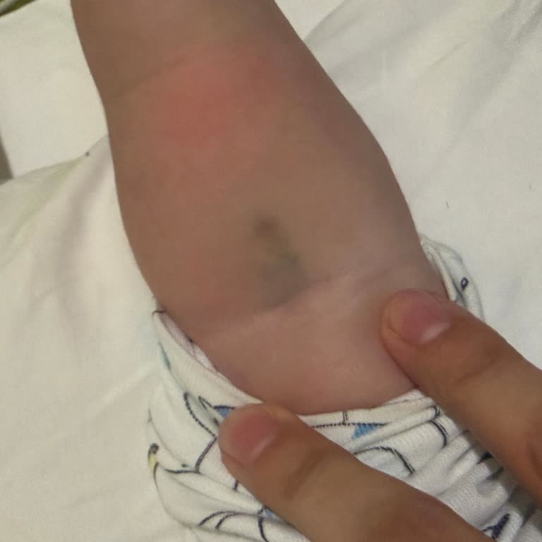 Ümraniye Devlet Hastanesinde Çocuk Kan Alımında Aşırı Delme Ve Şiddetli Morluklar