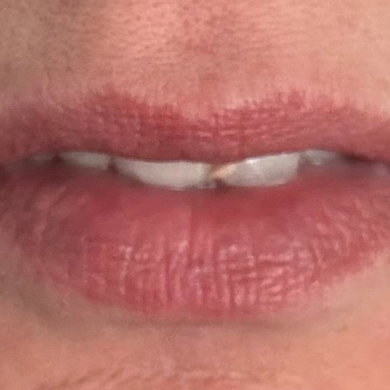 Dudak Renklendirme İşleminde Sonuç Yok, 8 Bin TL İadesi Talebi