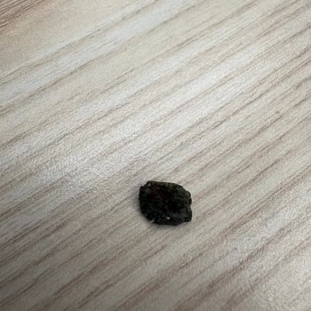İçinde Taş Çıkan Kuruyemişte Diş Kırılması Ve Sağlık Tehlikesi
