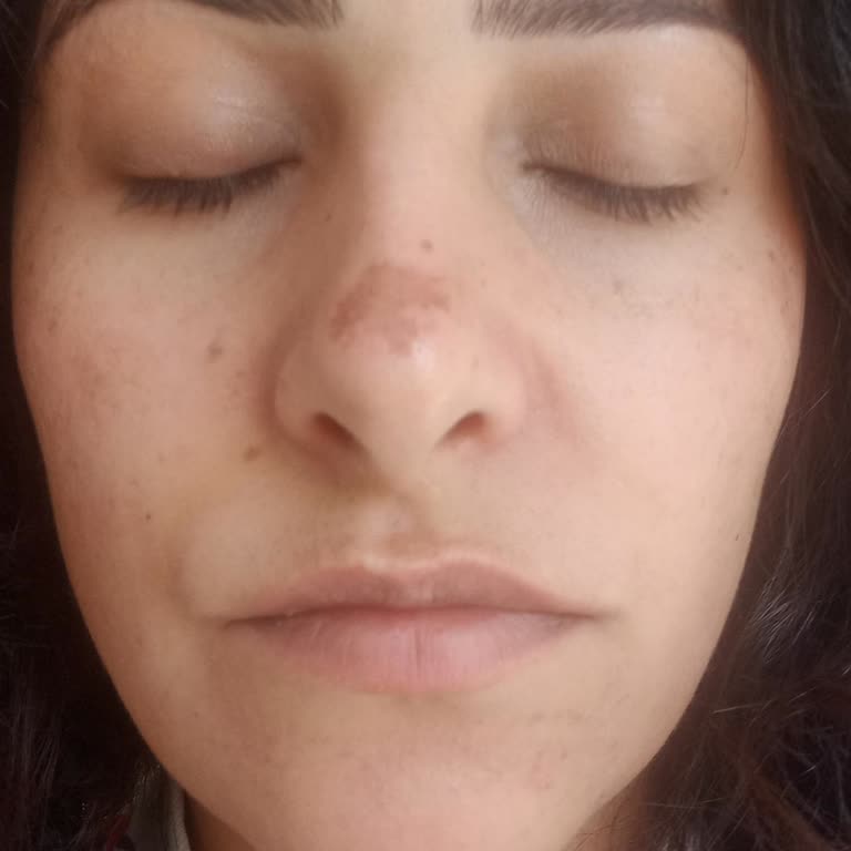 Ozon Cilt Bakımı Sonrası Kalıcı Tahriş Ve Lekeler İçin Sorumluluk Talebi