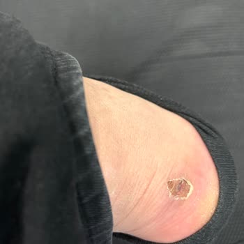 Derimod Ayakkabısının Topuğunda Şiddetli Ağrı Ve Yaraya Neden Olması