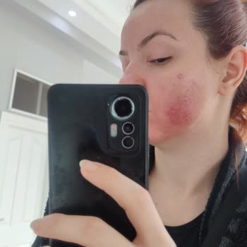 Golden Güzellik Merkezi'nde Yosun Peeling Sonrası Cilt Yanığı Ve 20 Bin TL İade Talebi