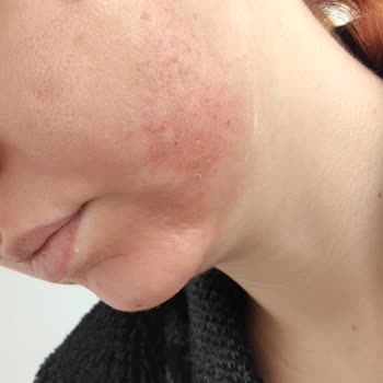 Golden Güzellik Merkezi'nde Yosun Peeling Sonrası Cilt Yanığı Ve 20 Bin TL İade Talebi