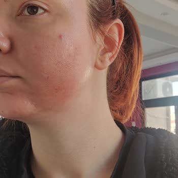 Golden Güzellik Merkezi'nde Yosun Peeling Sonrası Cilt Yanığı Ve 20 Bin TL İade Talebi