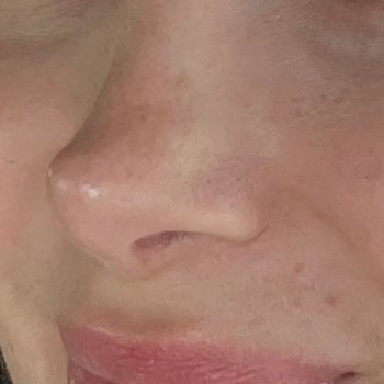 Rinoplasti Sonrası Asimetri Ve Sert Kitle, İzinsiz TikTok Paylaşımı