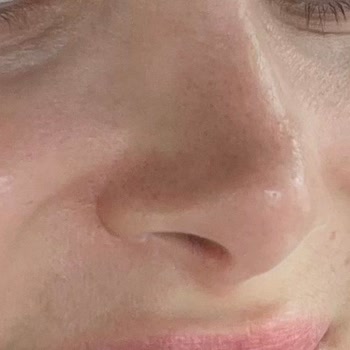 Rinoplasti Sonrası Asimetri Ve Sert Kitle, İzinsiz TikTok Paylaşımı