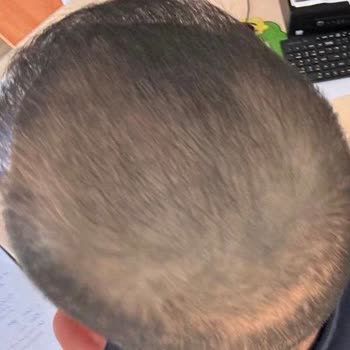 Saç Simülasyonunda Yeşil Renk Ve Ağrılı Deneyim