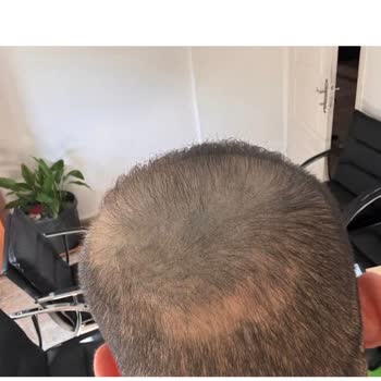 Saç Simülasyonunda Yeşil Renk Ve Ağrılı Deneyim