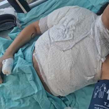 Lüks Yeşil Erciş Firmasının Muavinin Kaynar Su Dökülmesi Ve Yanık Sonrası Acil Müdahale İhmali