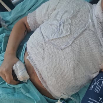 Lüks Yeşil Erciş Firmasının Muavinin Kaynar Su Dökülmesi Ve Yanık Sonrası Acil Müdahale İhmali