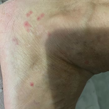 Walk In Otel’de Tahtakurusu Ve Hijyen Sorunları Sağlık Riskine Yol Açtı