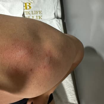 Stajyer Estetisyen Uygulaması Sonrası Yanıklar Ve Başarısız Epilasyon