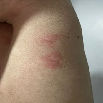 Stajyer Estetisyen Uygulaması Sonrası Yanıklar Ve Başarısız Epilasyon