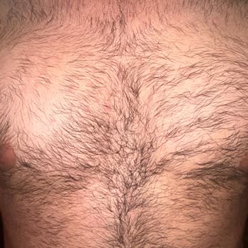 Stajyer Estetisyen Uygulaması Sonrası Yanıklar Ve Başarısız Epilasyon