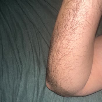 Stajyer Estetisyen Uygulaması Sonrası Yanıklar Ve Başarısız Epilasyon