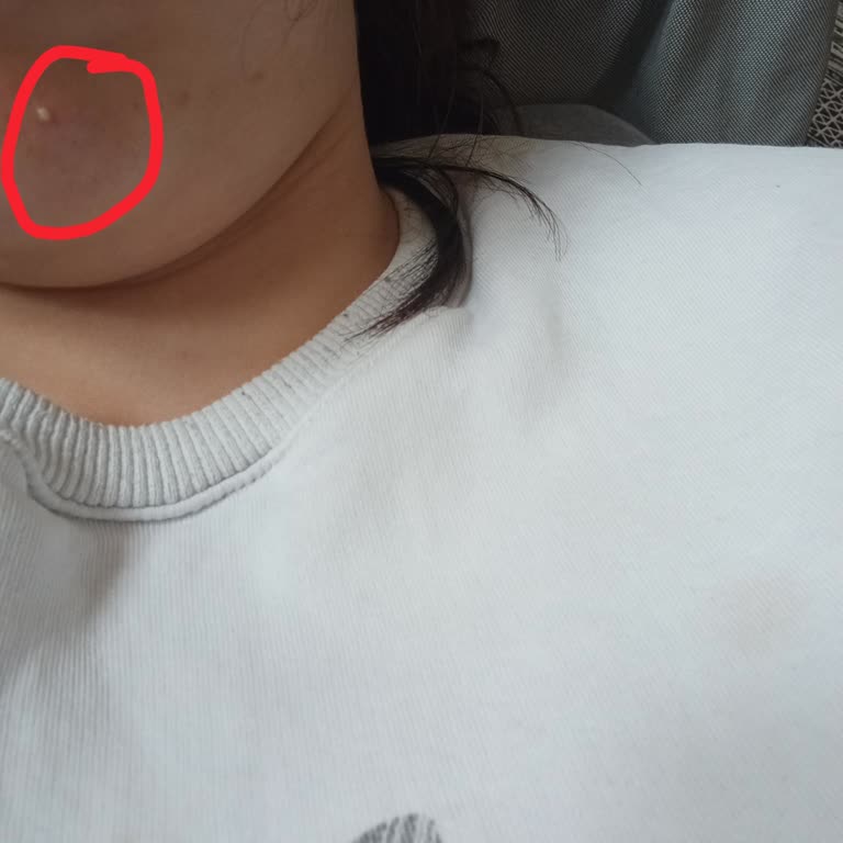 Wiwify Yüz Nemlendiricisi Nedeniyle Çene Bölgesinde Şiddetli Sivilce Ve Cevapsız İletişim