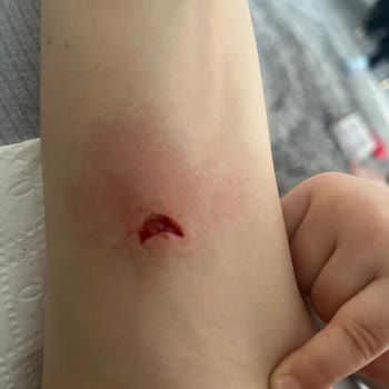 Korkmaz Tavasının Vidalı Parçasının Patlaması Ve Ciddi Kol Yaralanması