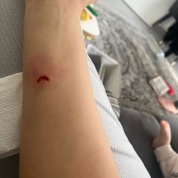 Korkmaz Tavasının Vidalı Parçasının Patlaması Ve Ciddi Kol Yaralanması
