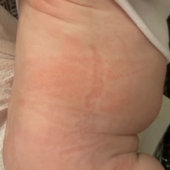 Bebeğimin Cildinde Şampuan Nedeniyle Egzama Oluştu, 712 TL İade Talep Ediyorum