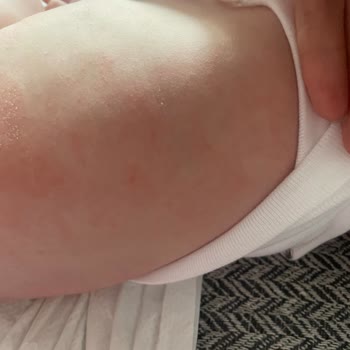 Bebeğimin Cildinde Şampuan Nedeniyle Egzama Oluştu, 712 TL İade Talep Ediyorum